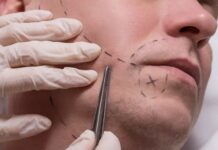 How Much Moustache Transplant Will Cost You in Kerala? Moustache Transplant