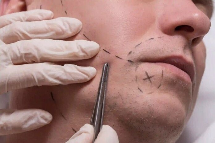 Moustache Transplant